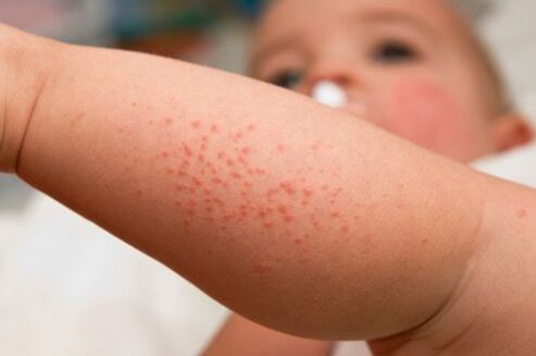 A alerxia nun neno como síntoma da presenza de vermes